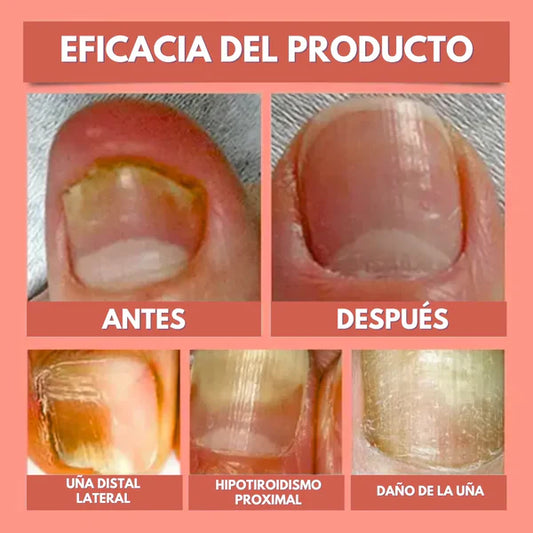 DermaPatch™ Parche Antifúngico para Hongo