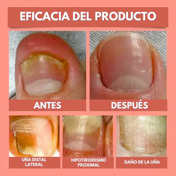 DermaPatch™ Parche Antifúngico para Hongo